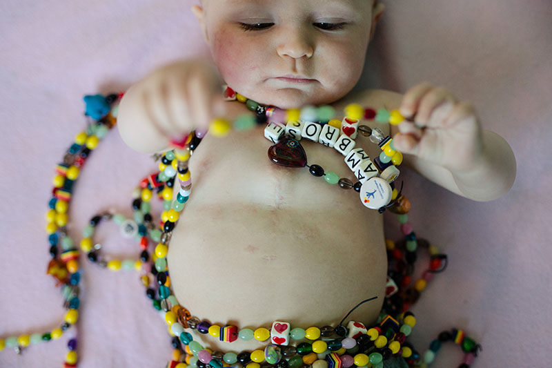 baby heart surgery scar and beads