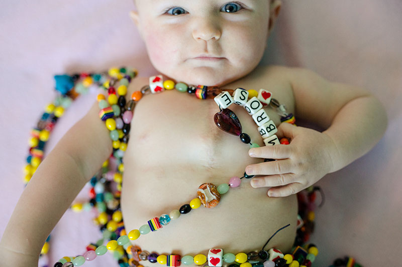 baby heart surgery scar and beads of love