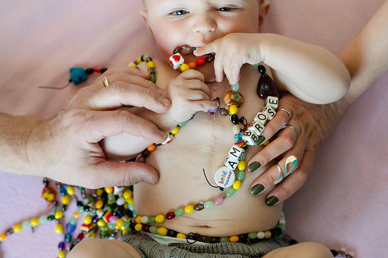 baby heart surgery scar and beads