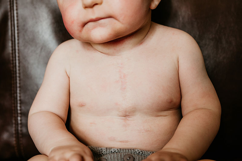 baby heart surgery scar